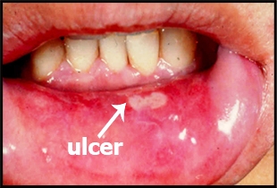Stomatitis வாய்ப் புண் Oral Ulcer
